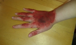 Maskeerattu palovamma - verinen käsi