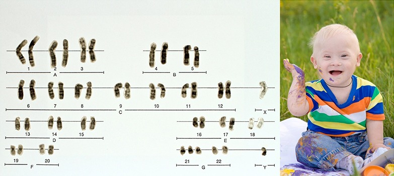 Downin syndrooma johtuu kromosomistomutaatiosta.