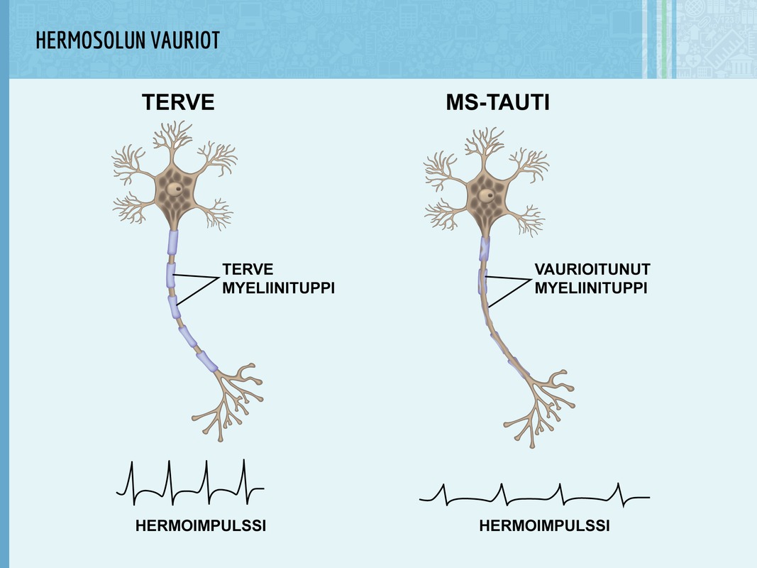 MS-taudissa heromosolujen myeliinitupet vaurioituvat.
