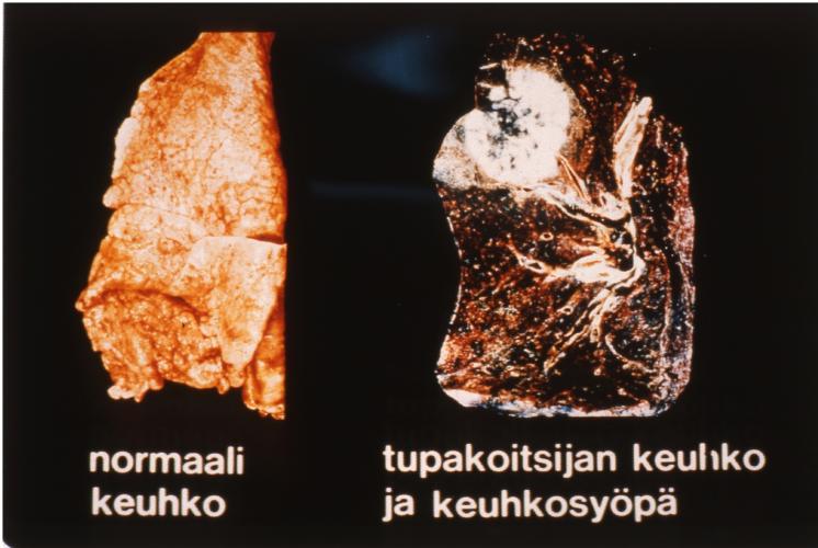 tupakka keuhkot.jpg